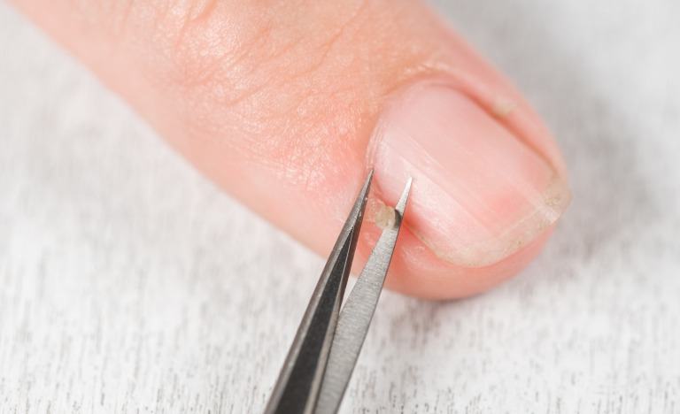 ささくれを治す方法