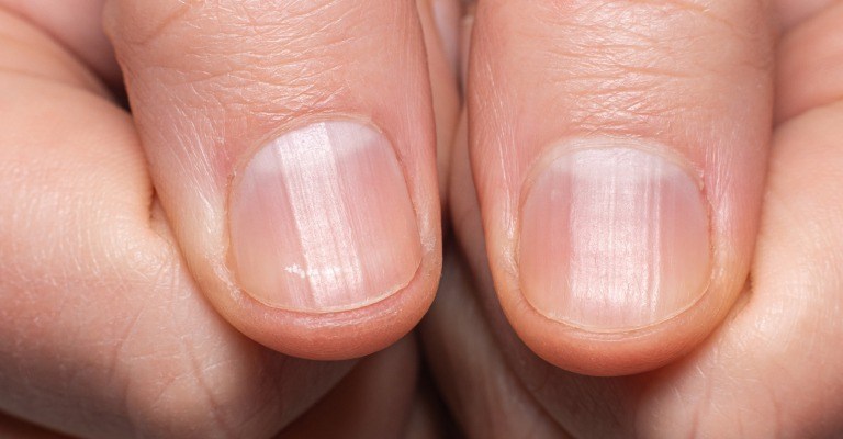 爪の縦線ケアにおすすめの対策