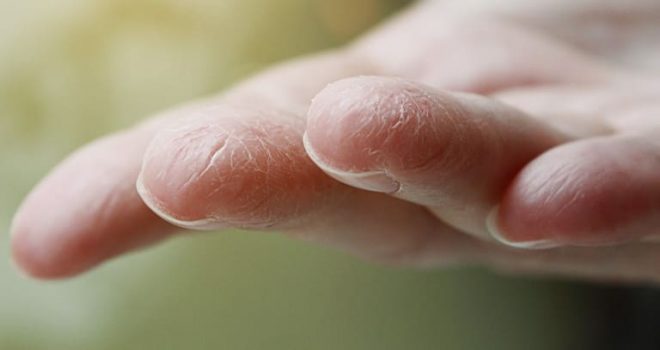 手の乾燥から起こりうる肌トラブル
