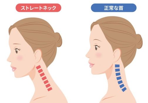 ストレートネック