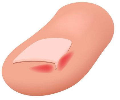 陥入爪（かんにゅうそう）