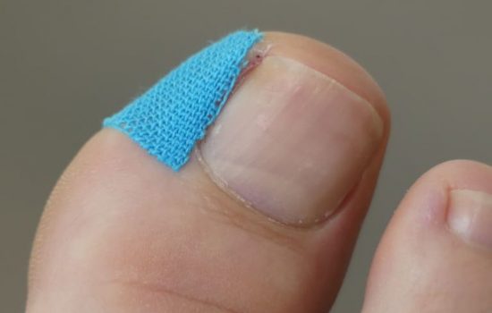 巻き爪の原因と対策