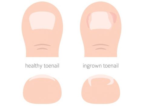 巻き爪の原因と対策