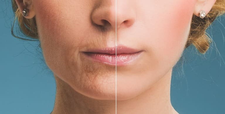 口元のシワ対策！シワの原因と予防方法まとめ