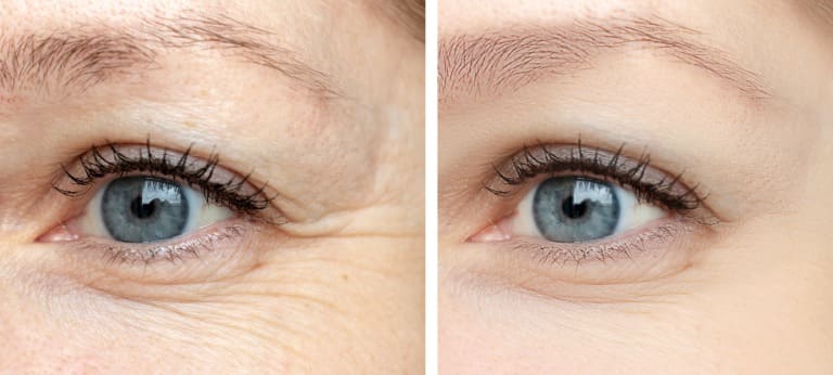 目元のしわ対策