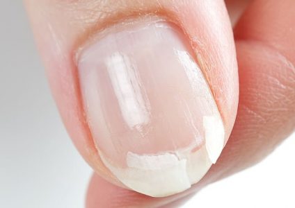 爪が割れやすい原因と対策！症状別のトラブルを防ぐ対処法まとめ